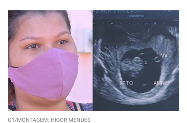 Photo of Grávida de siameses que dividem o mesmo coração dá detalhes comoventes da gestação