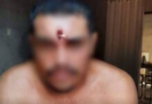 Photo of Homem é baleado na testa, vai para casa e só depois procura médico